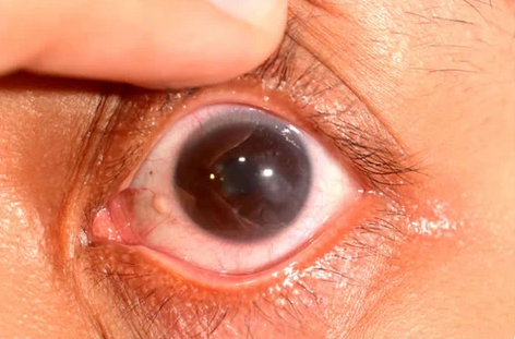 Type of Eye Infection best optical shop near me top online contact lens malaysia open eyes