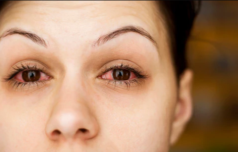 Contact Lens Discomfort What You Can Do best prices online optical shop near me top sale malaysia red eyes