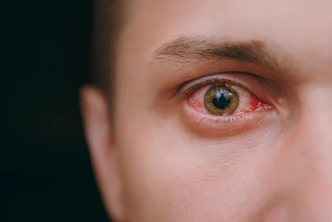 Safe Or Not Use Contact Lens While Sleeping top online lenses for sale malaysia optical shop near me red eyes