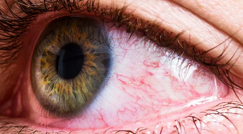 3 top reason you are not suitable for contact lenses top malaysia online shop retail for contact lens best prices sale red eyes