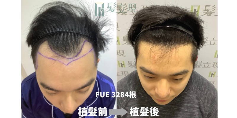 ★成功植髮手術分享★