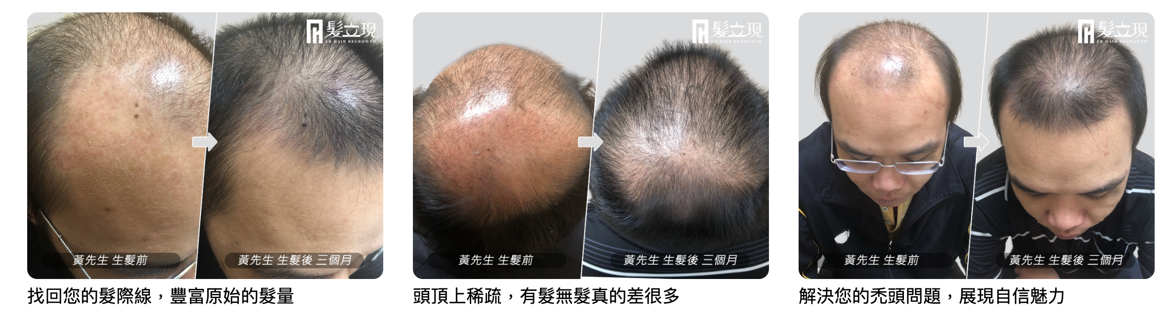  ★成功自然生髮分享★