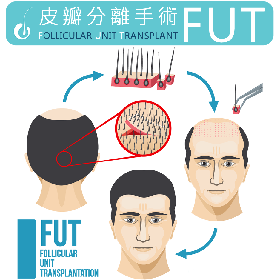 植髮示意圖3