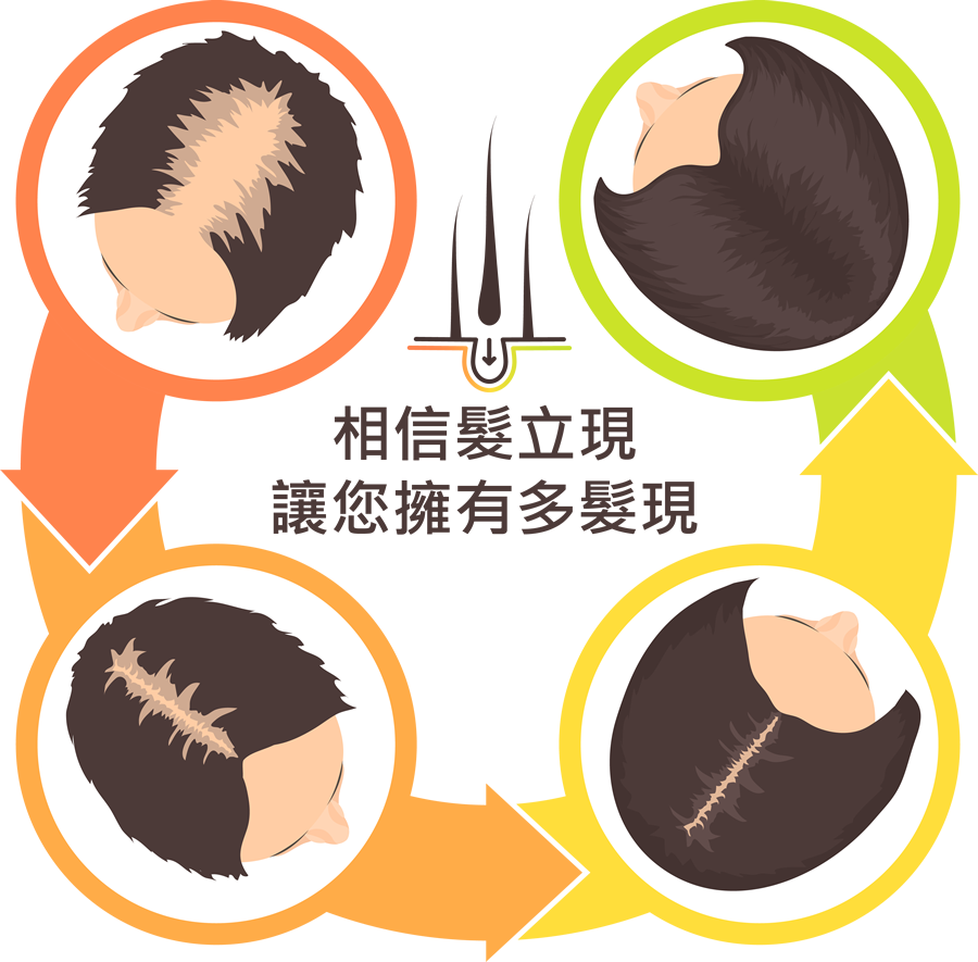 植髮示意圖2