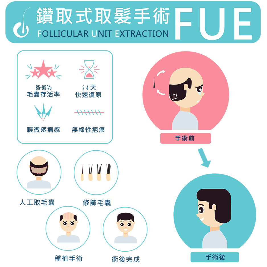 植髮示意圖1