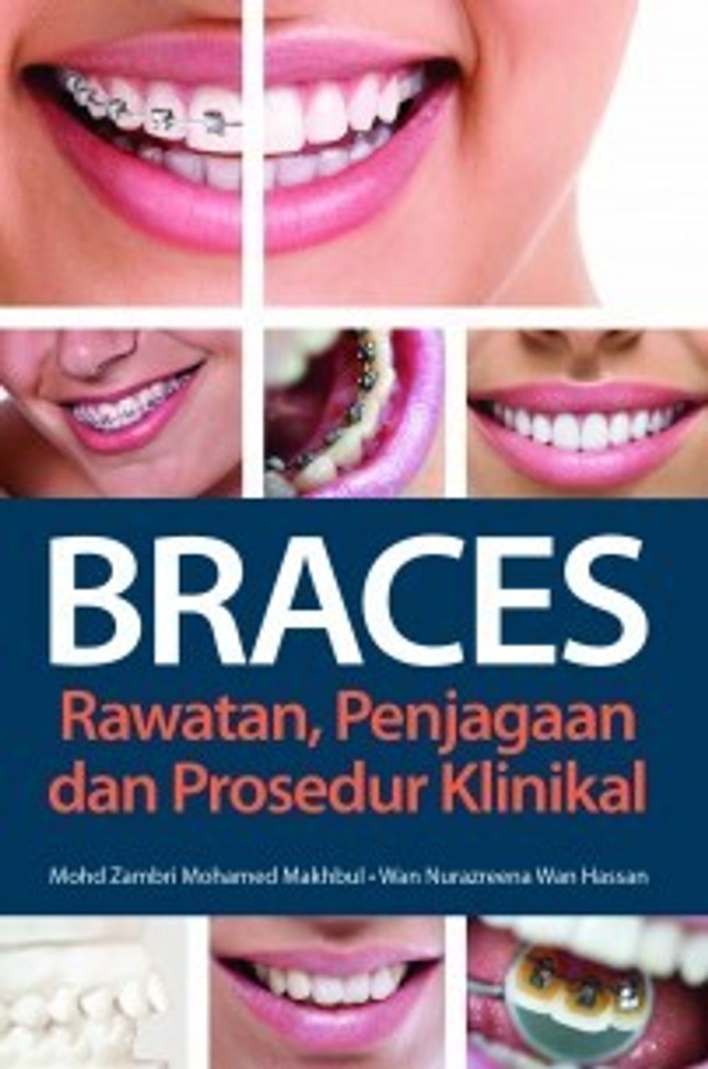 BRACES-305x305