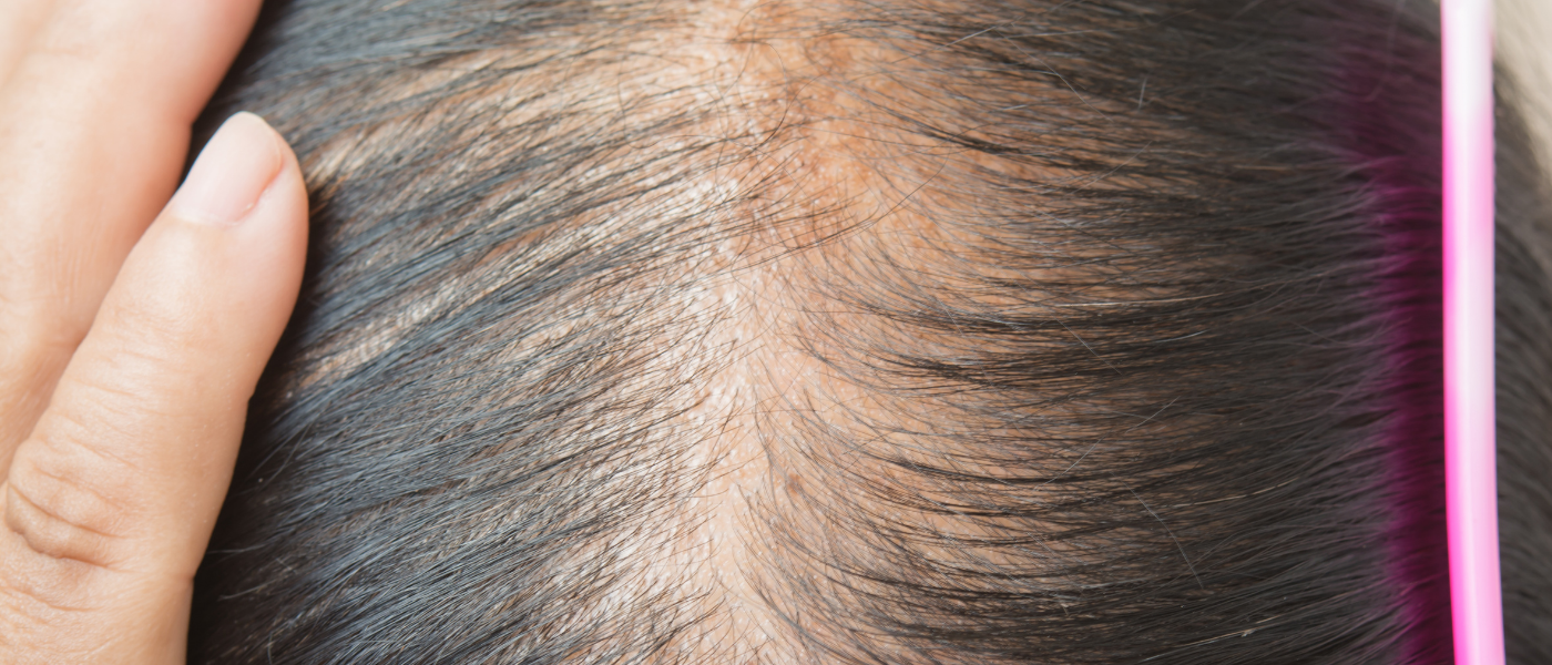  Menopause Hair Thinning: Where Did My Ponytail Go? (And What Actually Helps)