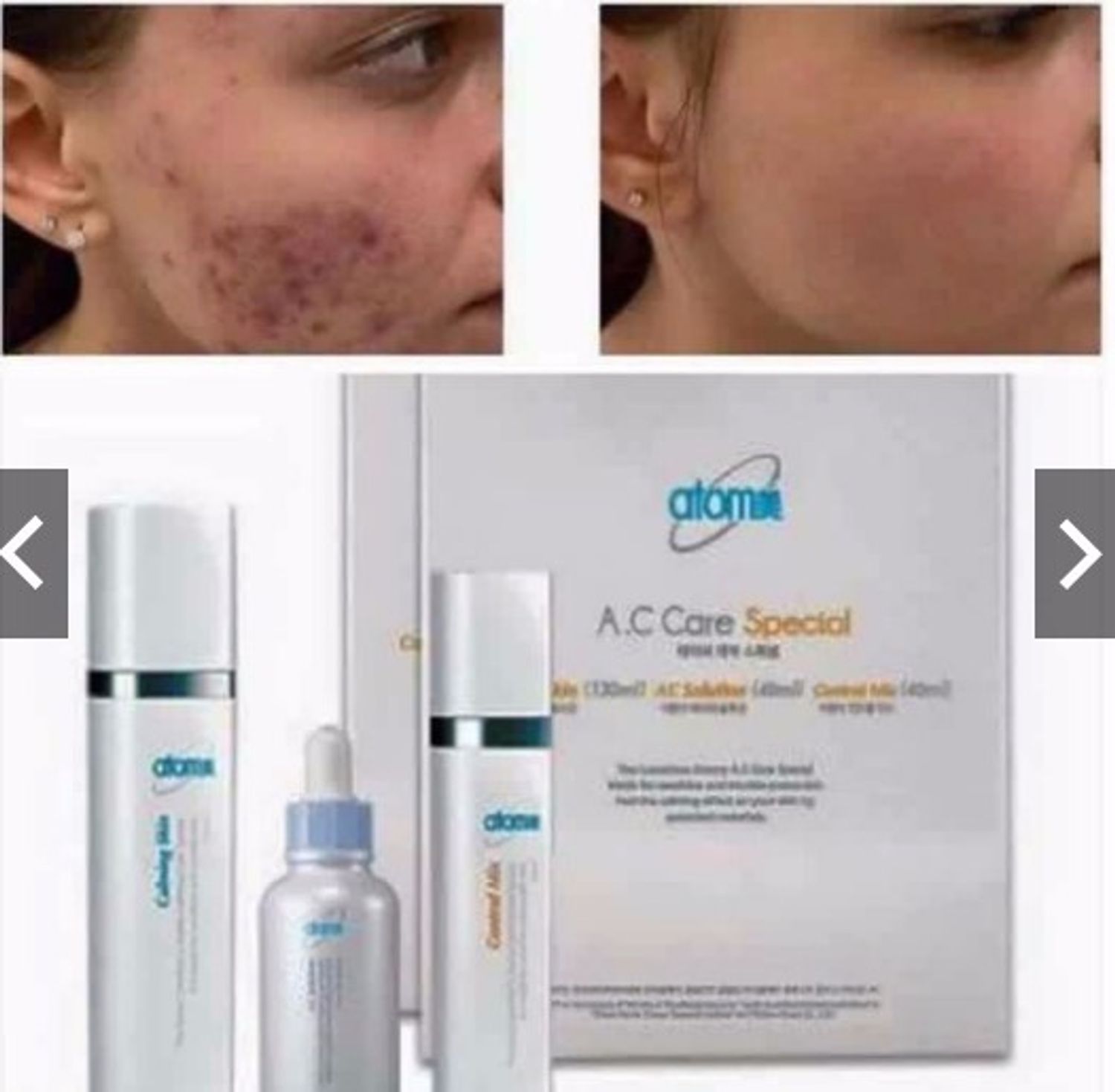 For acne scar