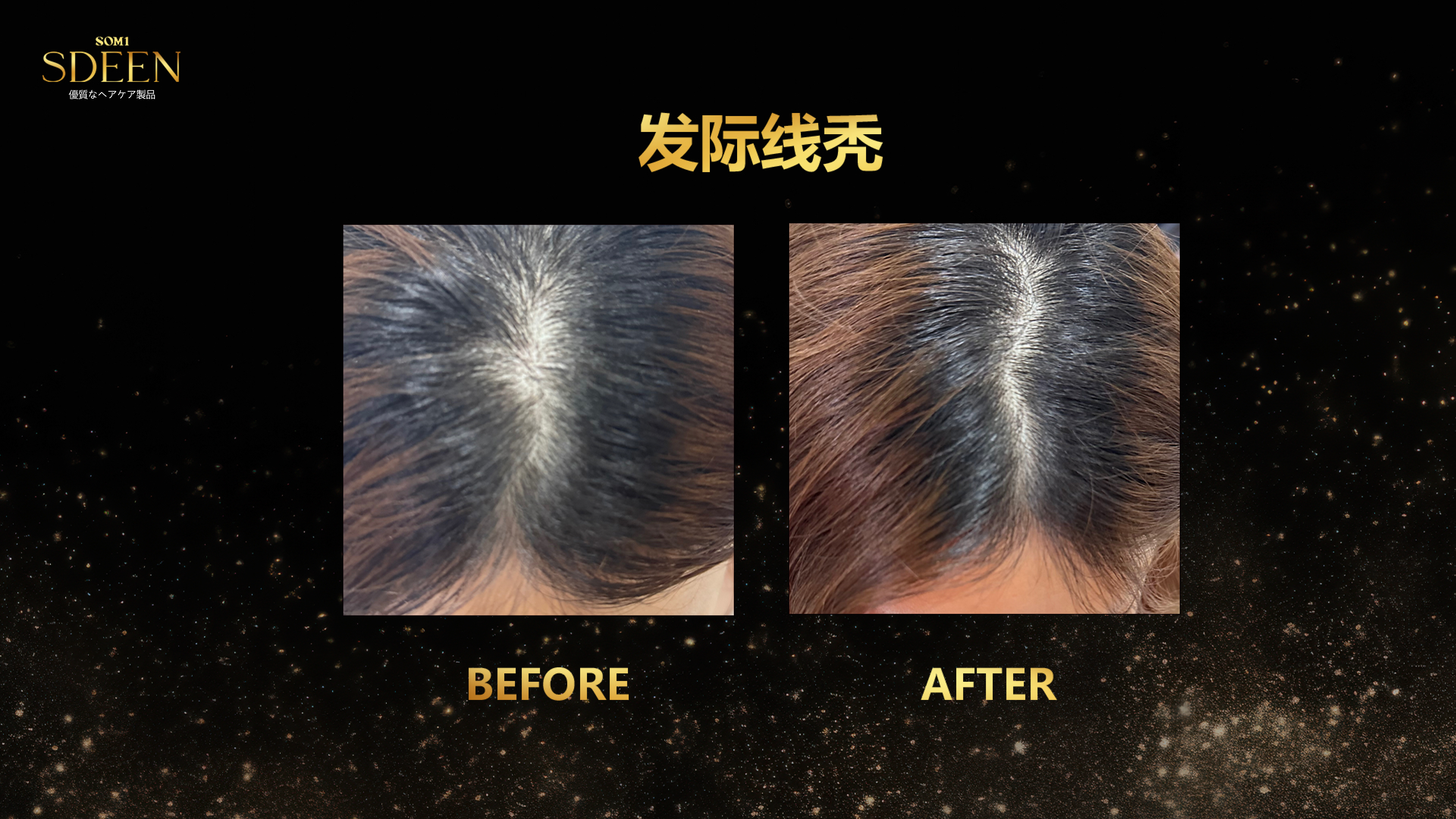 SDEEN TESTIMONIAL - 发际线秃2