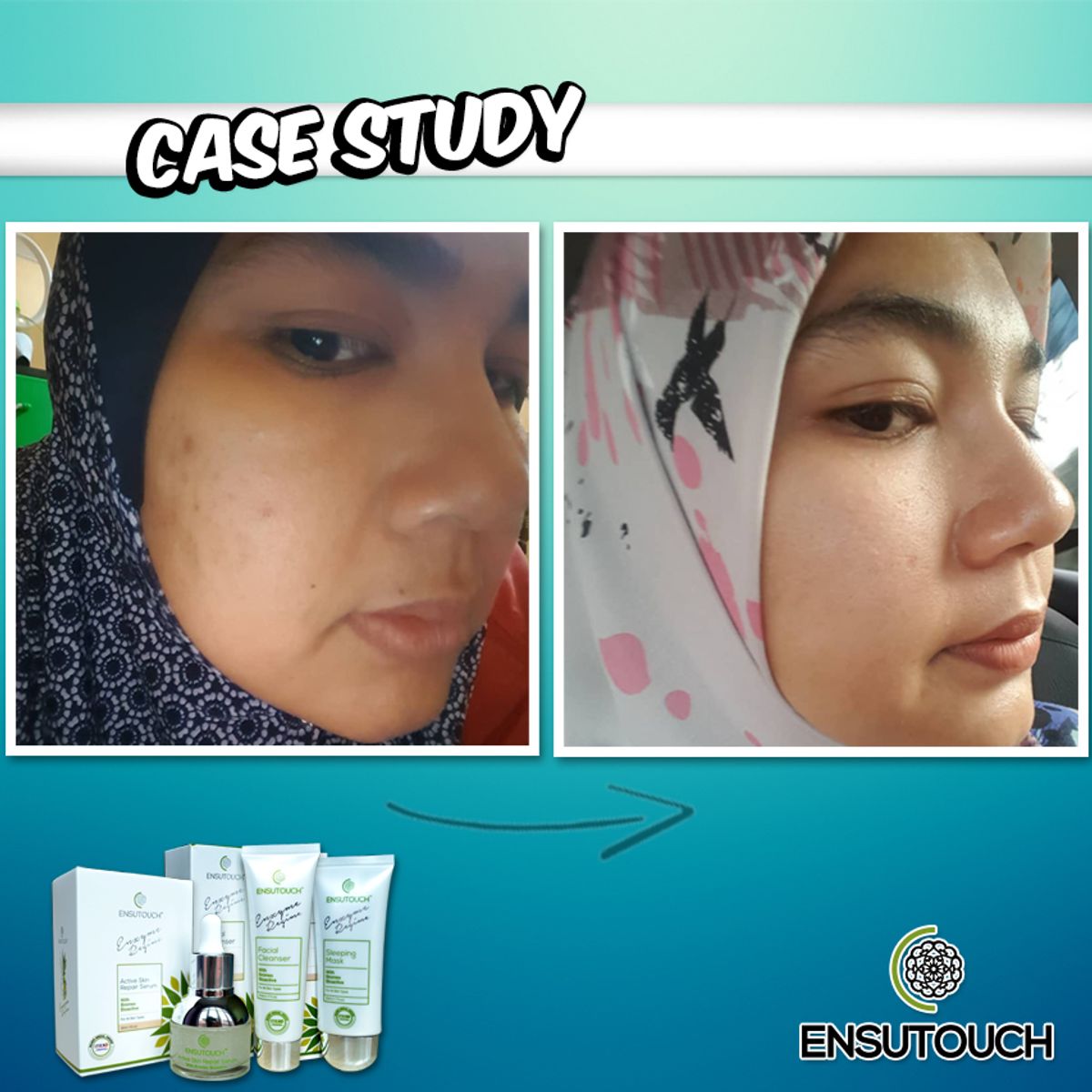 Kes 1 : Pengguna Parut Jerawat