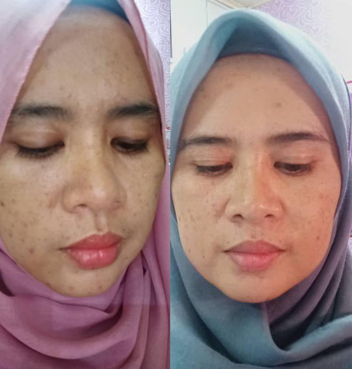 Case 9 : Jeragat, Jerawat Semakin Berkurang