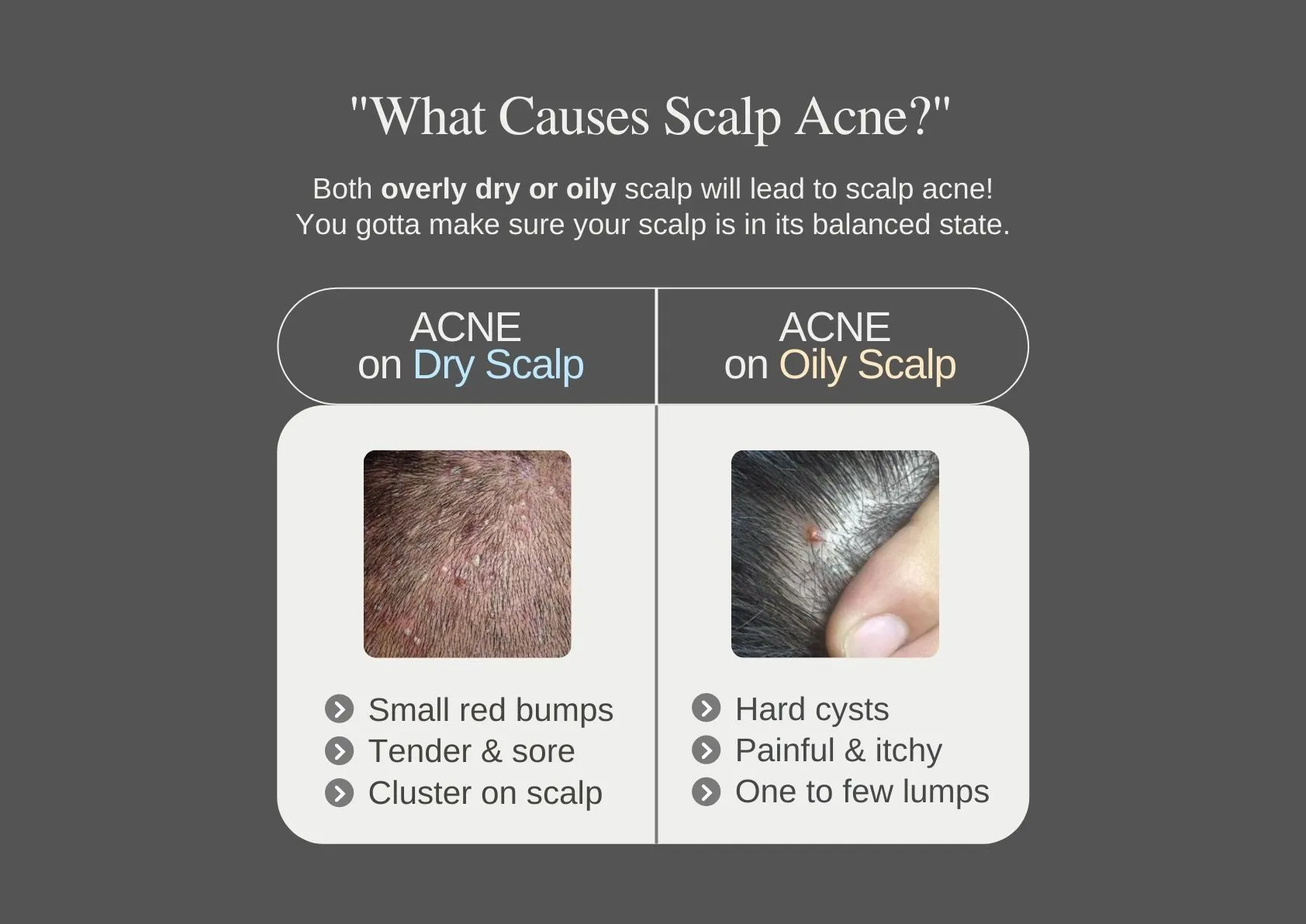 What causes scalp acne?