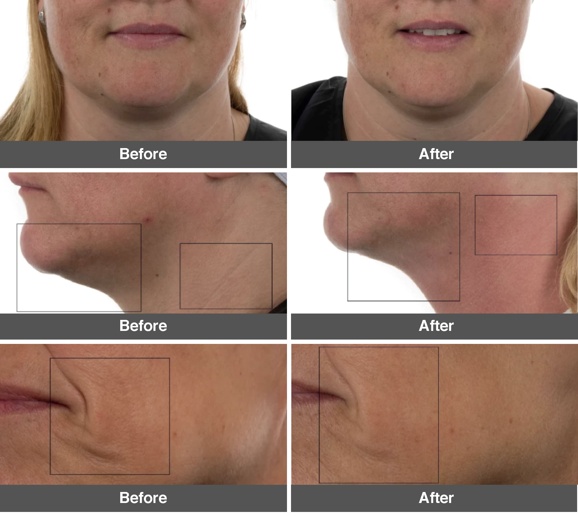 Lifetrons Ultra Facial Lift with Microcurrents & Light Therapy (EP400DS) Lifetrons