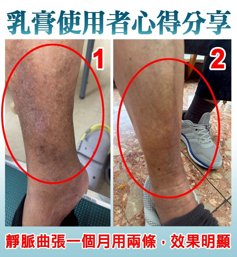 靜脈曲張_Varicose vein_下肢腫脹_色素沈著_血液滯流性皮膚炎