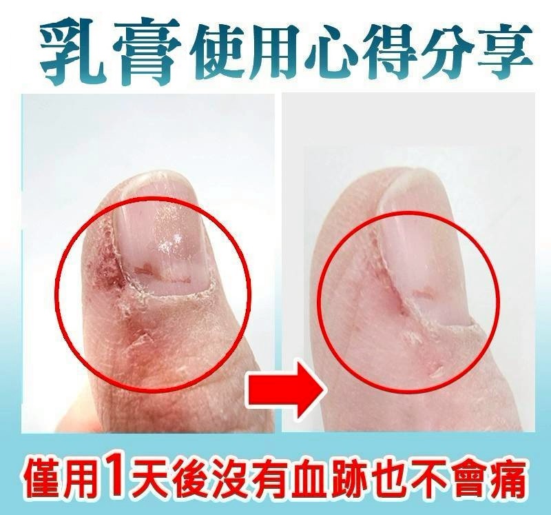 手指血跡_破皮