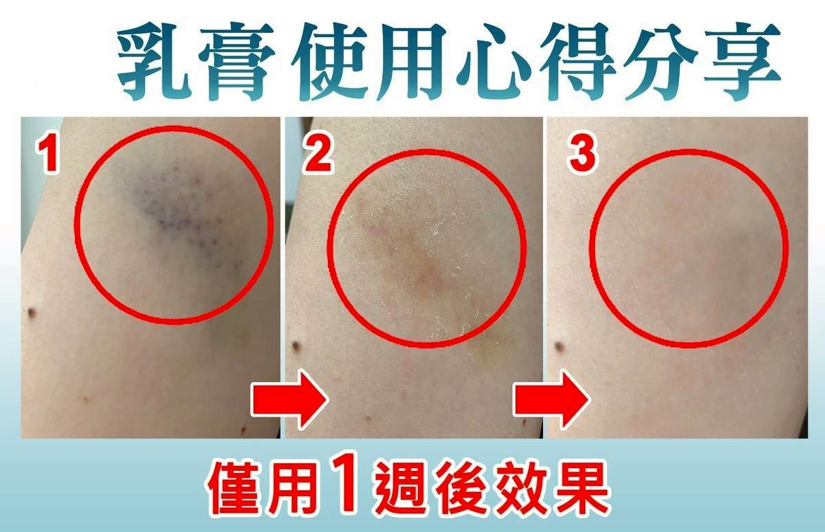 消瘀青_止癢_消腫_局部燙傷消腫