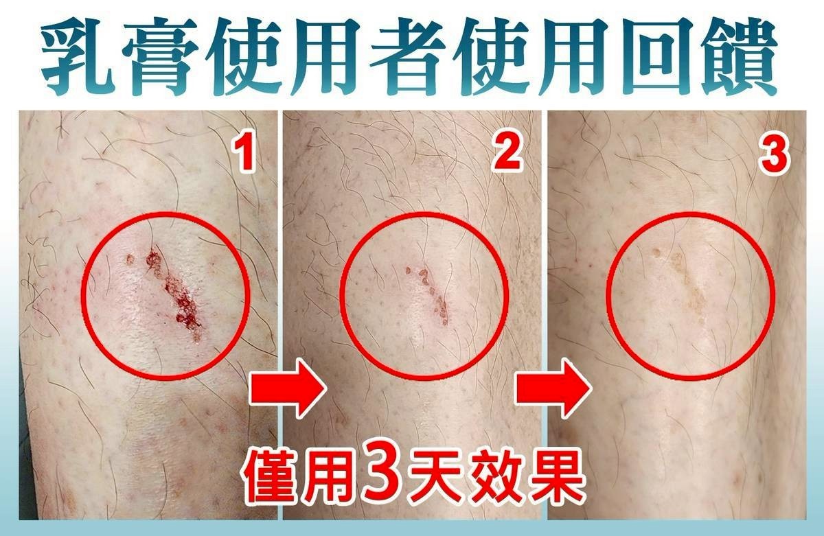 傷口性破皮_