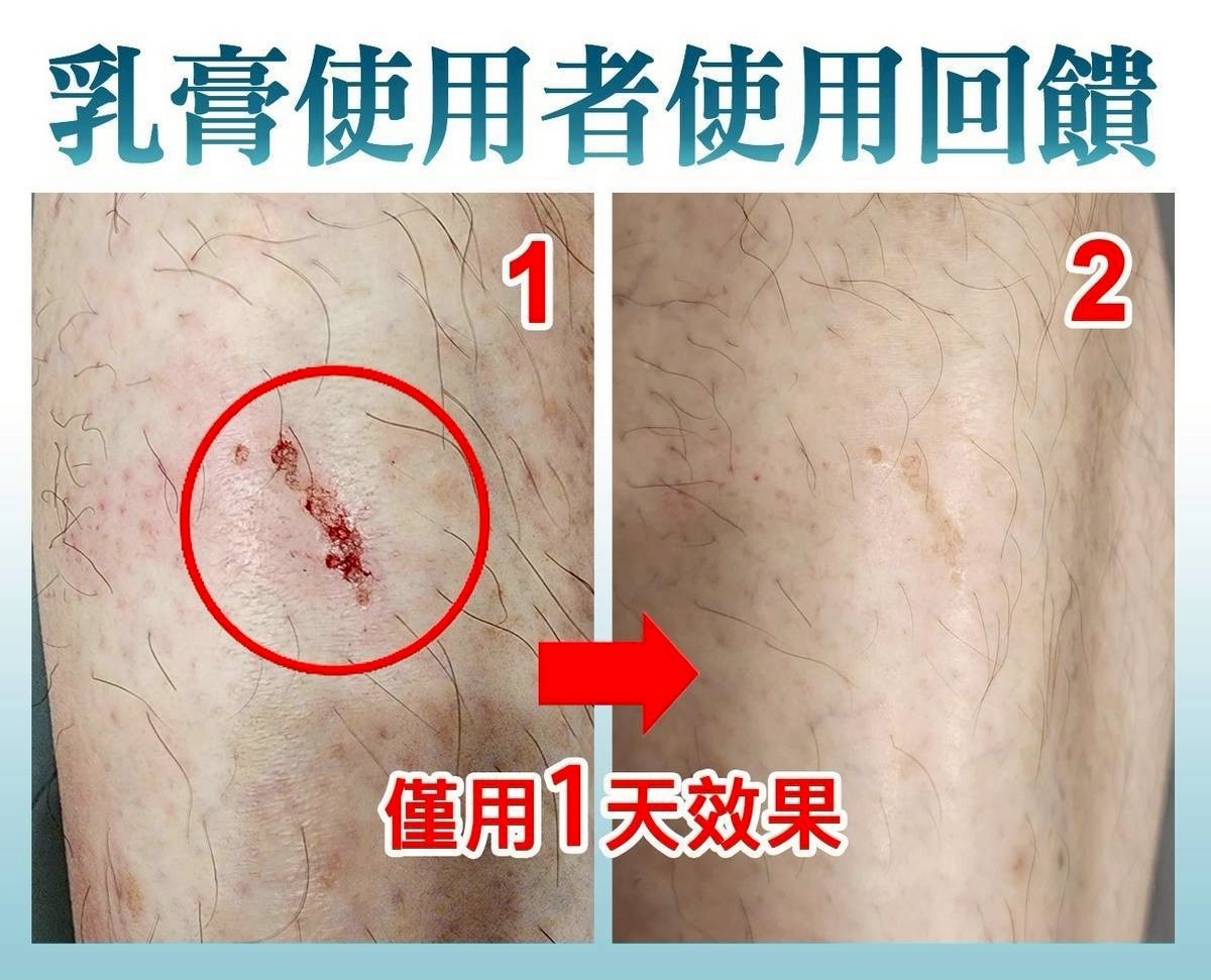 傷口性破皮_02
