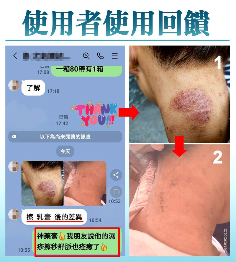 濕疹_皮膚炎_濕疹_粗皮_皮膚紅腫_發癢_乾燥_脫屑_丘疹_水泡_異位性皮膚炎