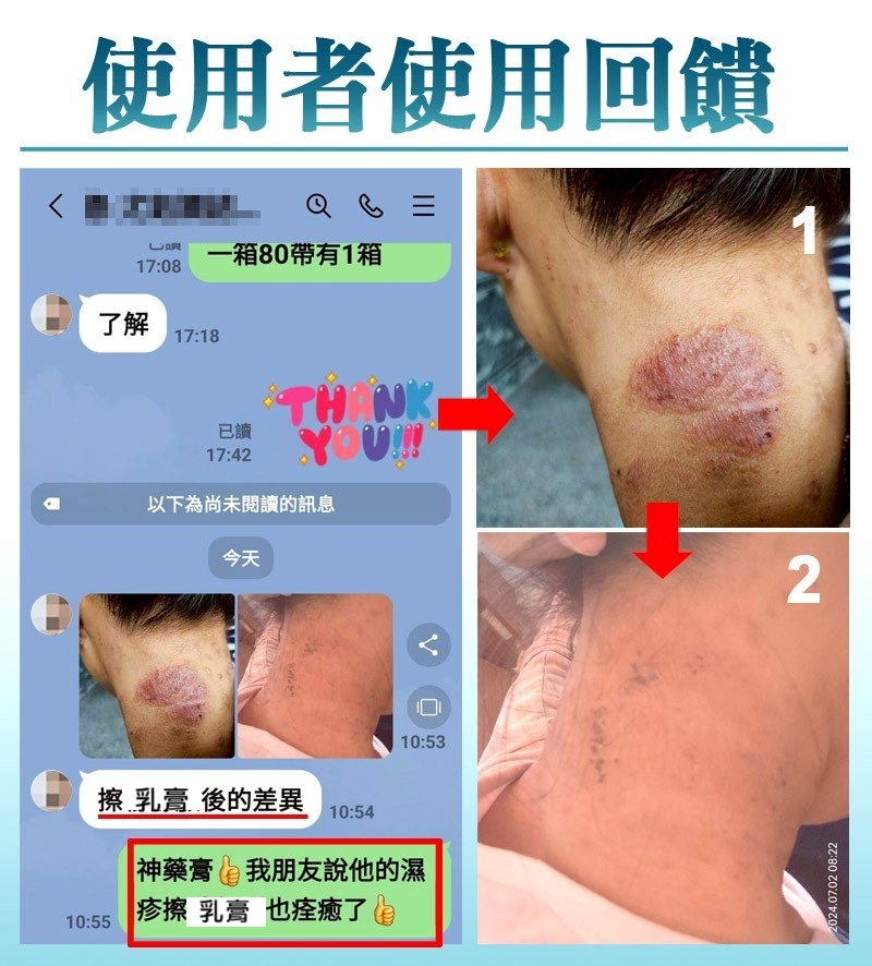 濕疹_皮膚炎_濕疹_粗皮_皮膚紅腫_發癢_乾燥_脫屑_丘疹_水泡_異位性皮膚炎