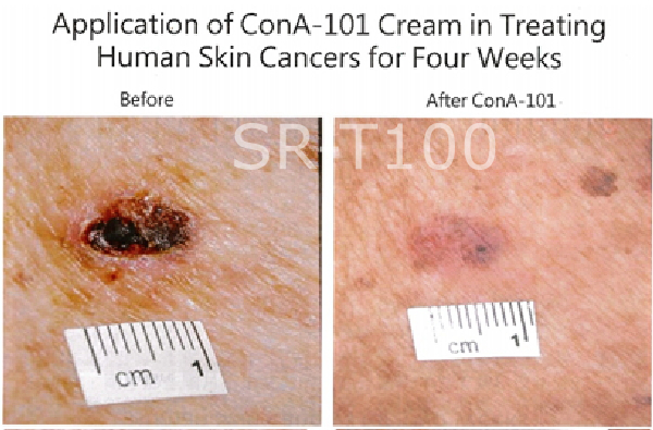 05_sr-t100_ treatment_Actinic Keratosis.jpg