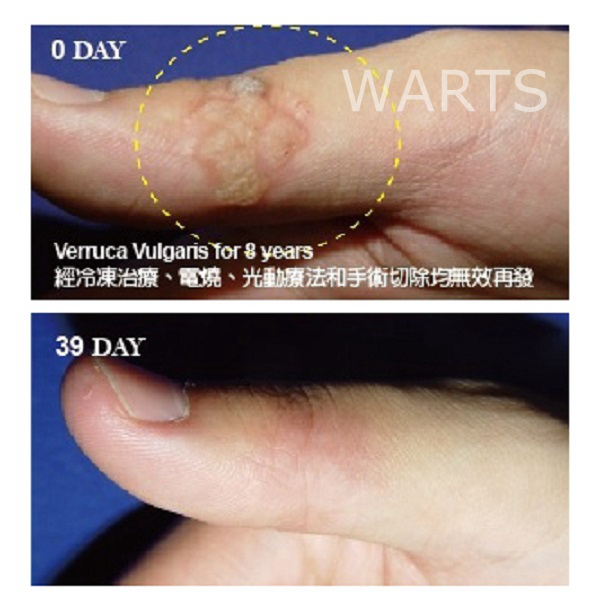 warts_HPVs_02.jpg
