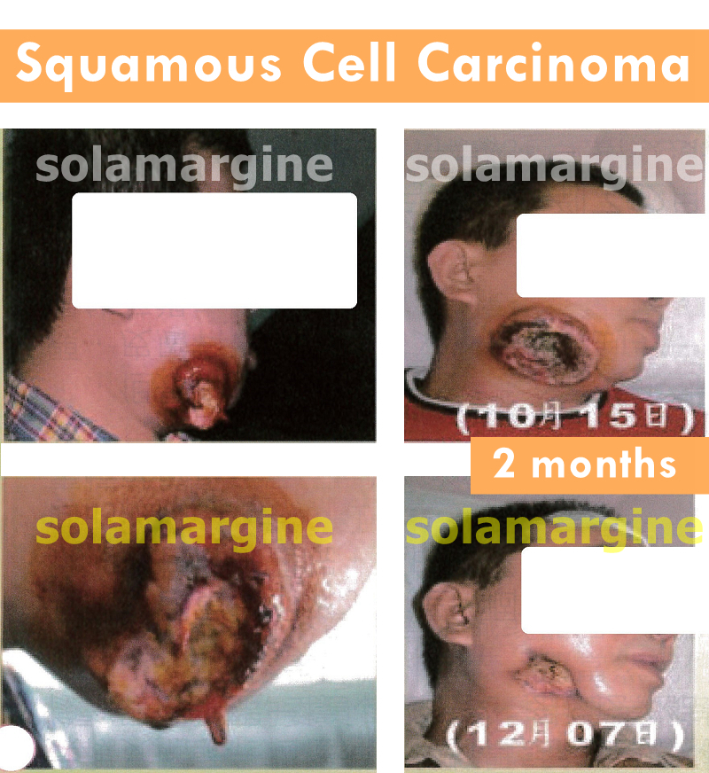 plokščialąstelinė karcinoma (scc) _006.jpg
