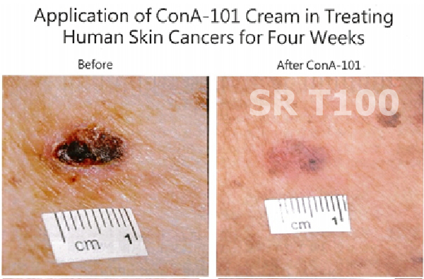 05_sr-t100_ treatment_Actinic Keratosis_03.jpg