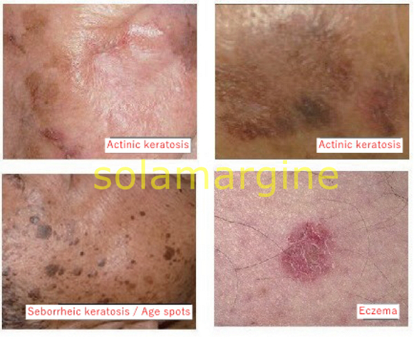 01_Actinic Keratosis_01.jpg