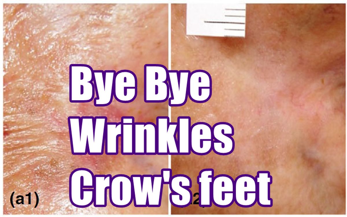 Farewell | Wrinkles | Crow's feet | Verruca Plana | Milia | Skin polyp | Syringoma