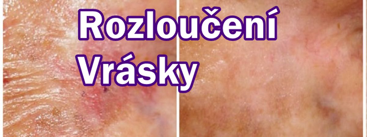 Sbohem | Vrásky | Vraní nohy | Verruca Plana | Milia | Kožní polyp | Syringoma