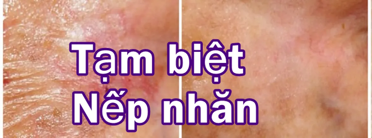 Chia tay | Nếp nhăn | Vết chân chim | Verruca Plana | Milia | Polyp da | Syringoma