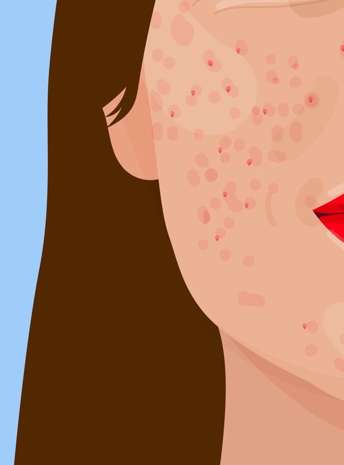 How To Treat Pimples