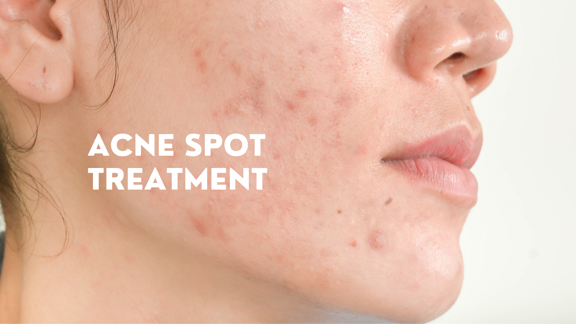 Acne spot treatment