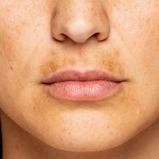 Uneven Tone Solution