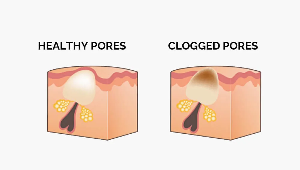 Clogged pores