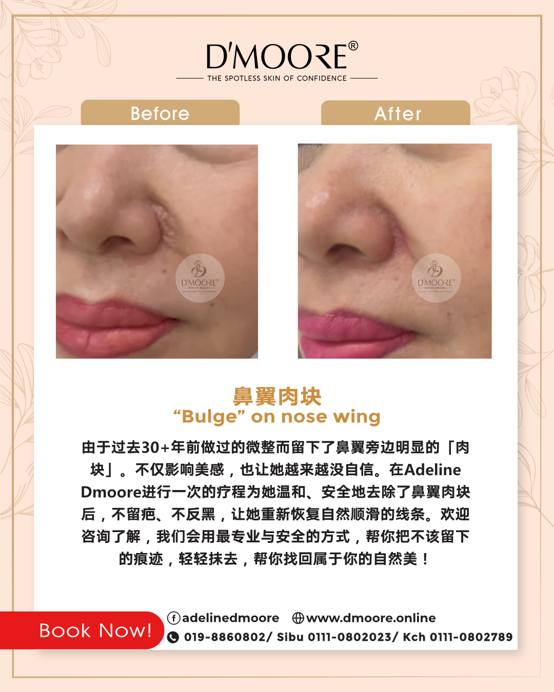 鼻botox