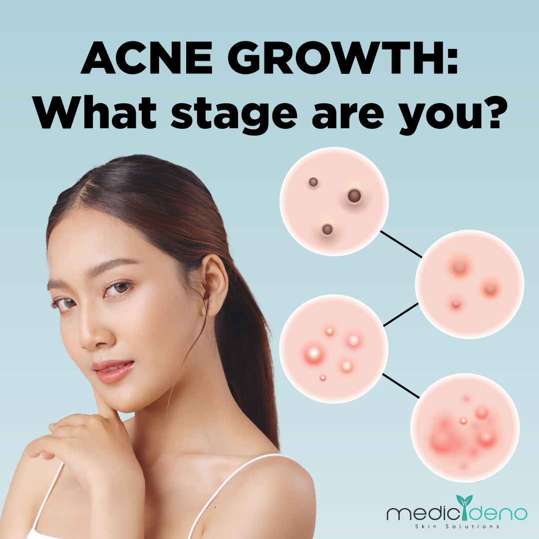 MD_Social_Apr23_Acne-Stages-1