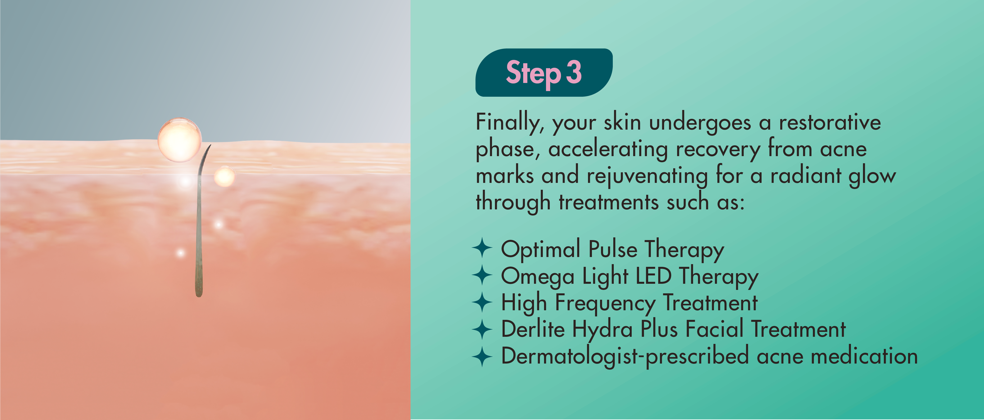 Finally, your skin undergoes a restorative phase, accelerating recovery from acne marks and rejuvenating for a radiant glow through treatments such as: Optimal Pulse Therapy Omega Light LED Therapy 4 High Frequency Treatment + Derlite Hydra Plus Facial Treatment + Dermatologist-prescribed acne medication