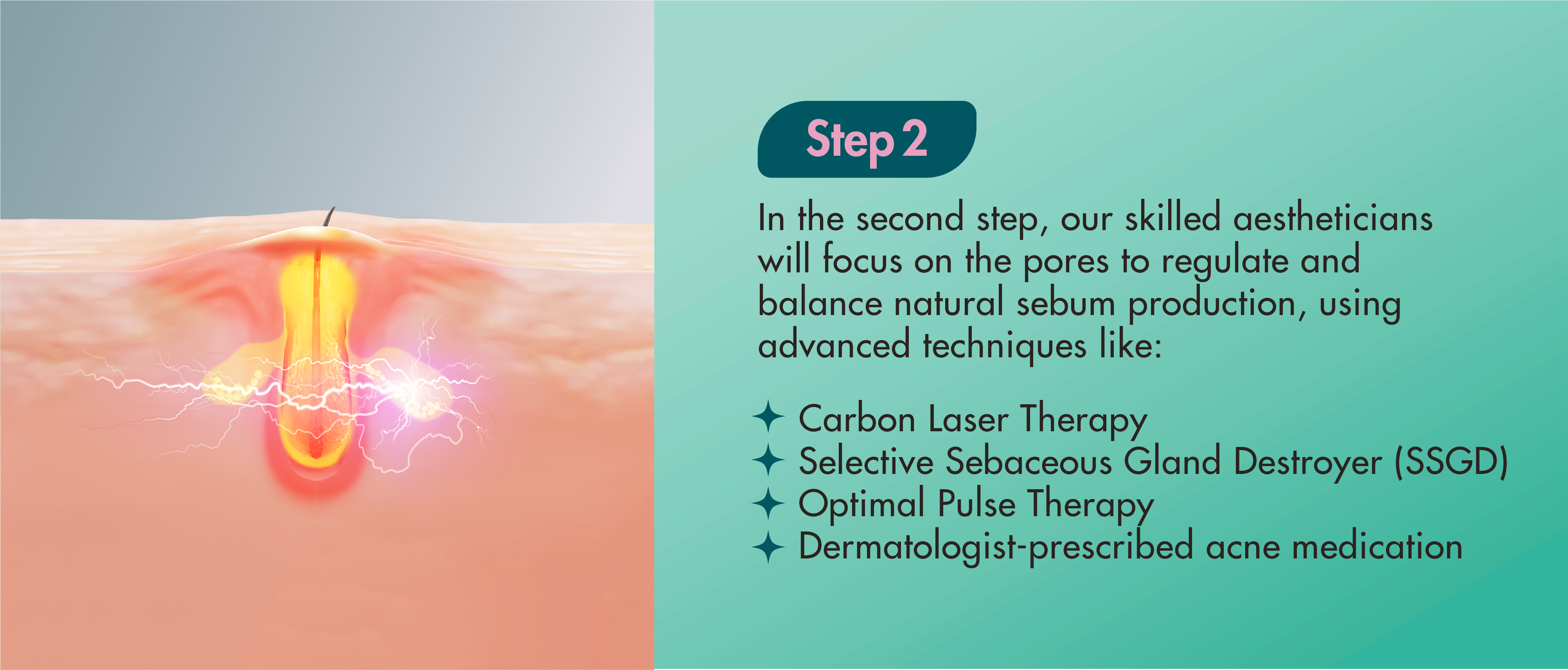 In the second step, our skilled aestheticians will focus on the pores to regulate and balance natural sebum production, using advanced techniques like: Carbon Laser Therapy Selective Sebaceous Gland Destroyer (SSGD) Optimal Pulse Therapy 4 Dermatologist-prescribed acne medication