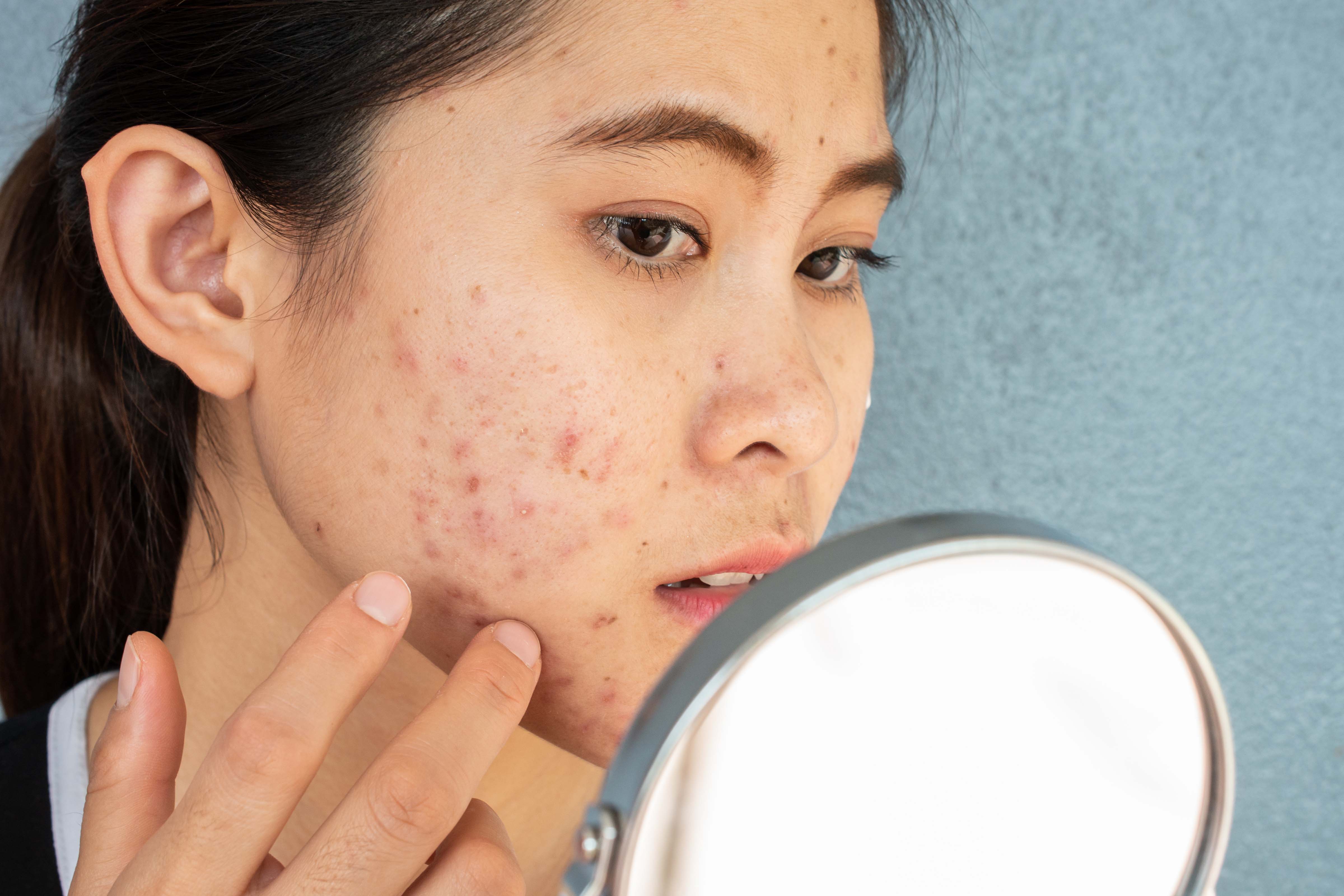 How to Clear Acne in 2 Weeks Before Raya – MEDICDENO