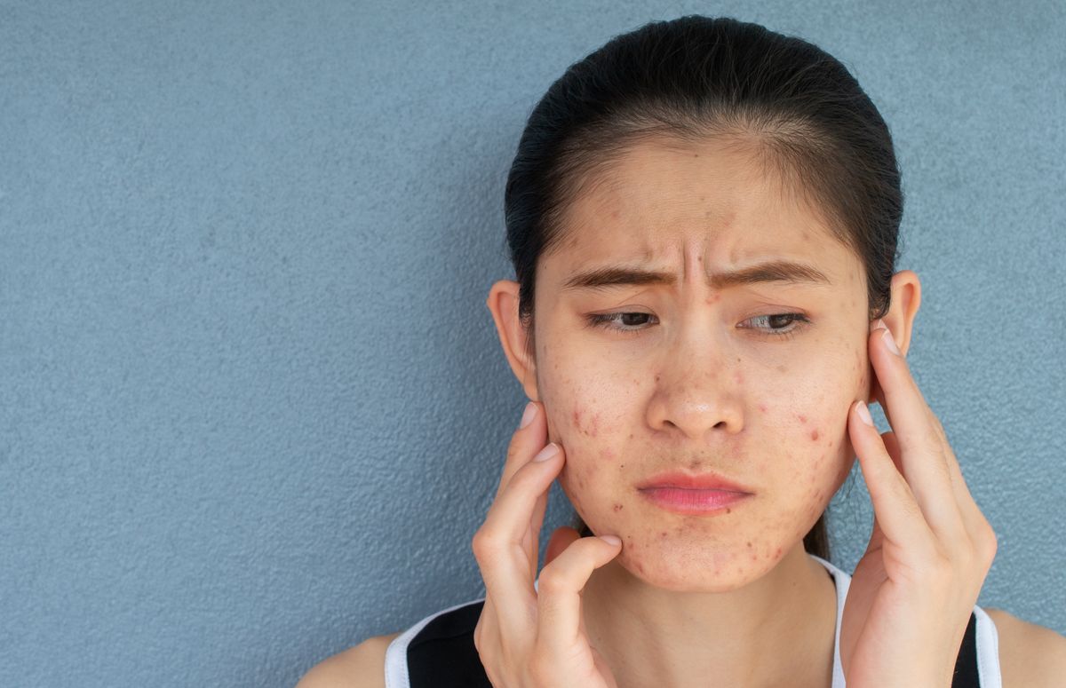 Which Type of Acne Scar Do You Have?