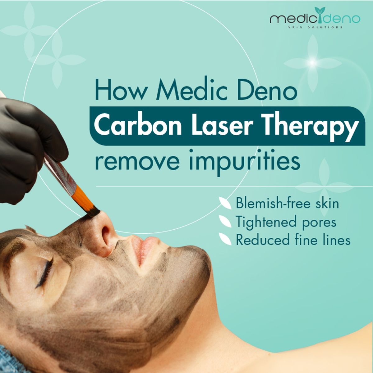 Zap Acne Away with Carbon Laser Therapy