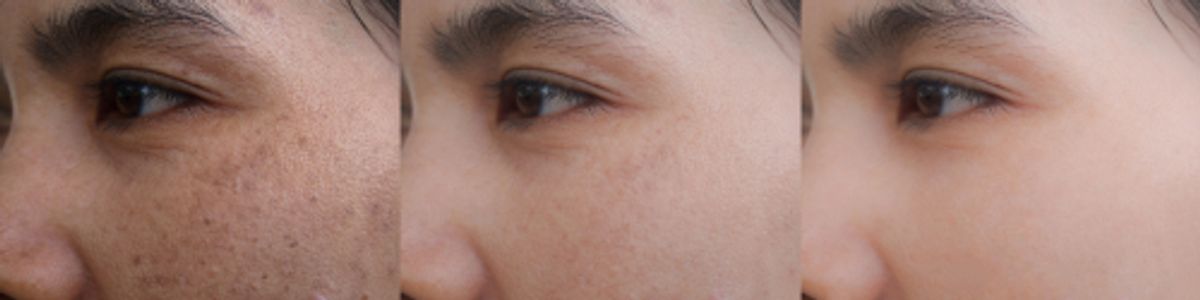 Hyperpigmentation No Longer an Issue with Optimal Pulse Therapy 