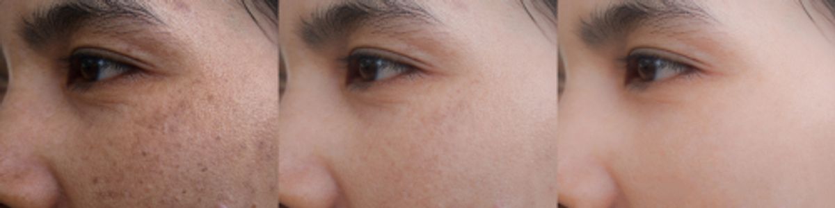 Hyperpigmentation No Longer an Issue with Optimal Pulse Therapy