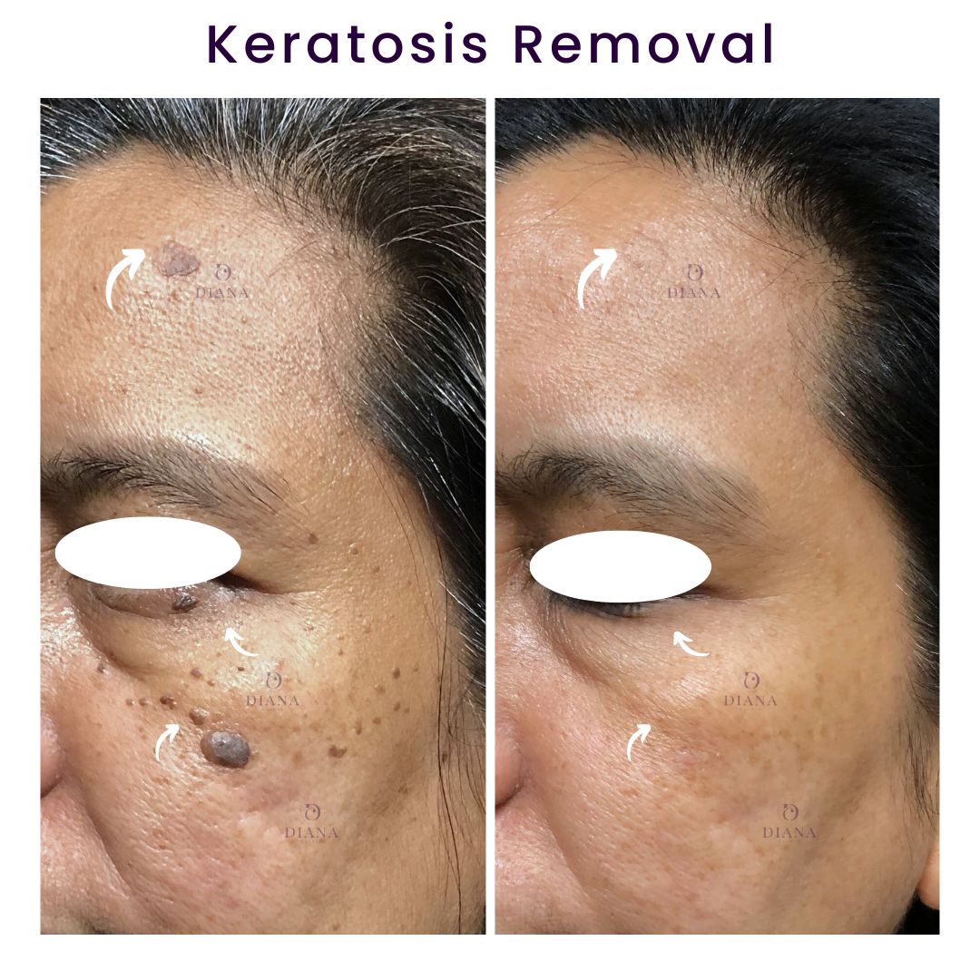 Seborrheic Keratosis Face Removal Seborrheic Keratosis Face Removal