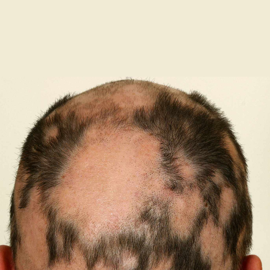 autoimmune baldness