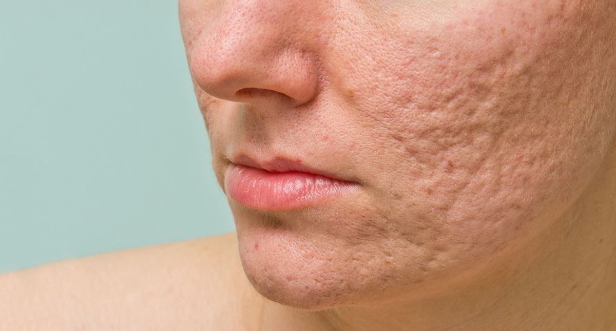 Understanding Different Types of Acne Scars and Your Path to Radiant Skin