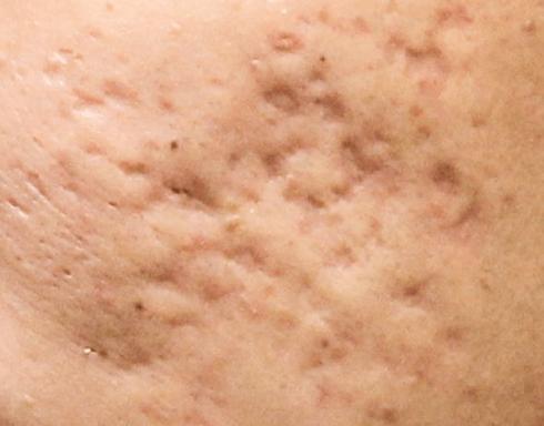 asla-landing-page-acne-scar-common-acne-image3