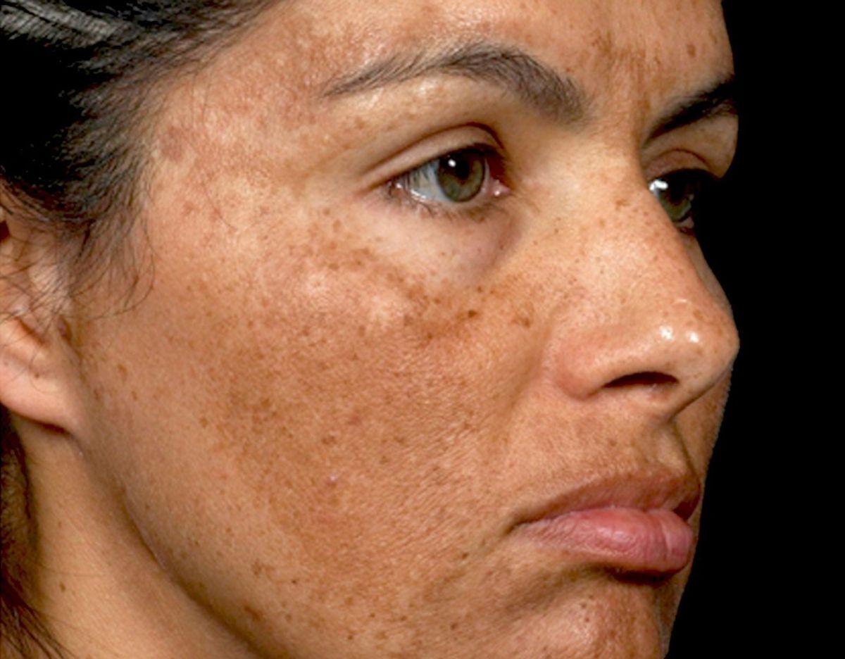 Fahami Melasma / Jeragat dan cara rawatan nya. 